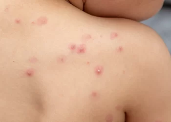 Viruela del Mono: se confirmaron dos casos en zona sur