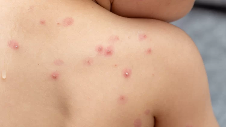 Viruela del Mono: se confirmaron dos casos en zona sur